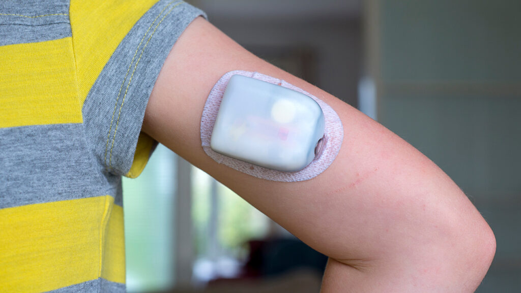 A diabetes management insulin pump on a girls arm